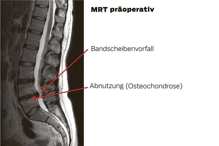 In der Kernspinaufnahme (MRT) ist deutlich zu sehen, wie die verrutschte Bandscheibe den Nervenkanal quetscht. Auch die Abnutzung der Wirbel ist auf dem Bild erkennbar. Bild: UKT